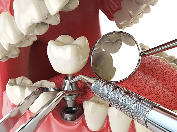 Best Emergency Dental Care for Broken or Chipped Teeth in Hialeah, FL